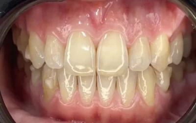 Alignement dentaire au Luxembourg : des aligneurs efficaces