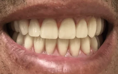 Aligneur dentaire à Esch-sur-Alzette : corriger le positionnement des dents