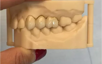 Les facettes céramiques : un incontournable de l’esthétique du sourire au Luxembourg