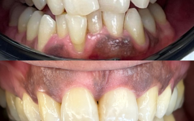 L’importance d’avoir des dents bien alignées